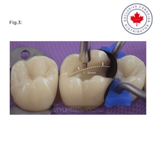 LM-Arte™ Posterior Misura | Curion Dental