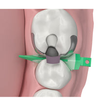 Strata-G™ Wedges - Soft-Faced, Anatomically Shaped Interproximal Wedges, Green wedge Adaptation