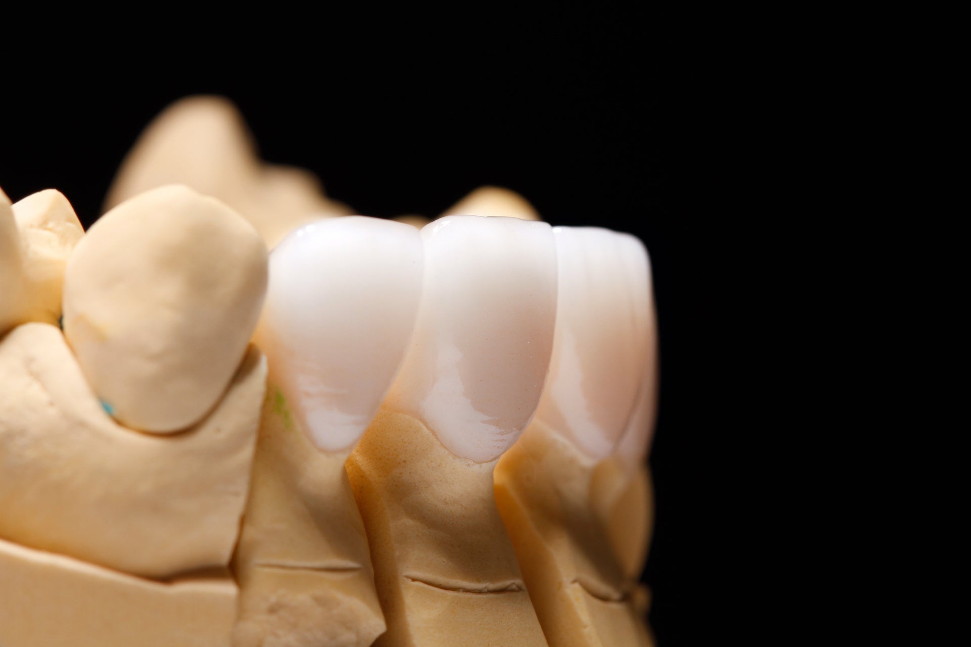 Porcelain Veneers: From Preparation to Cementation