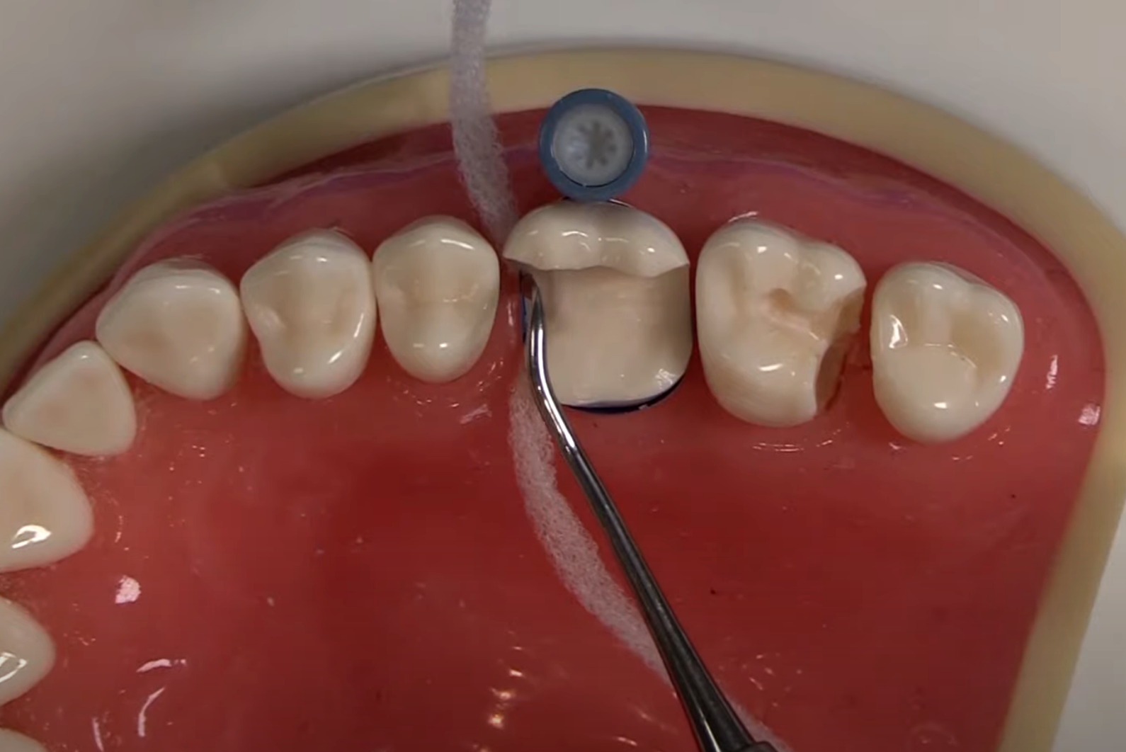 Deep Margin Elevation for the General Dentist