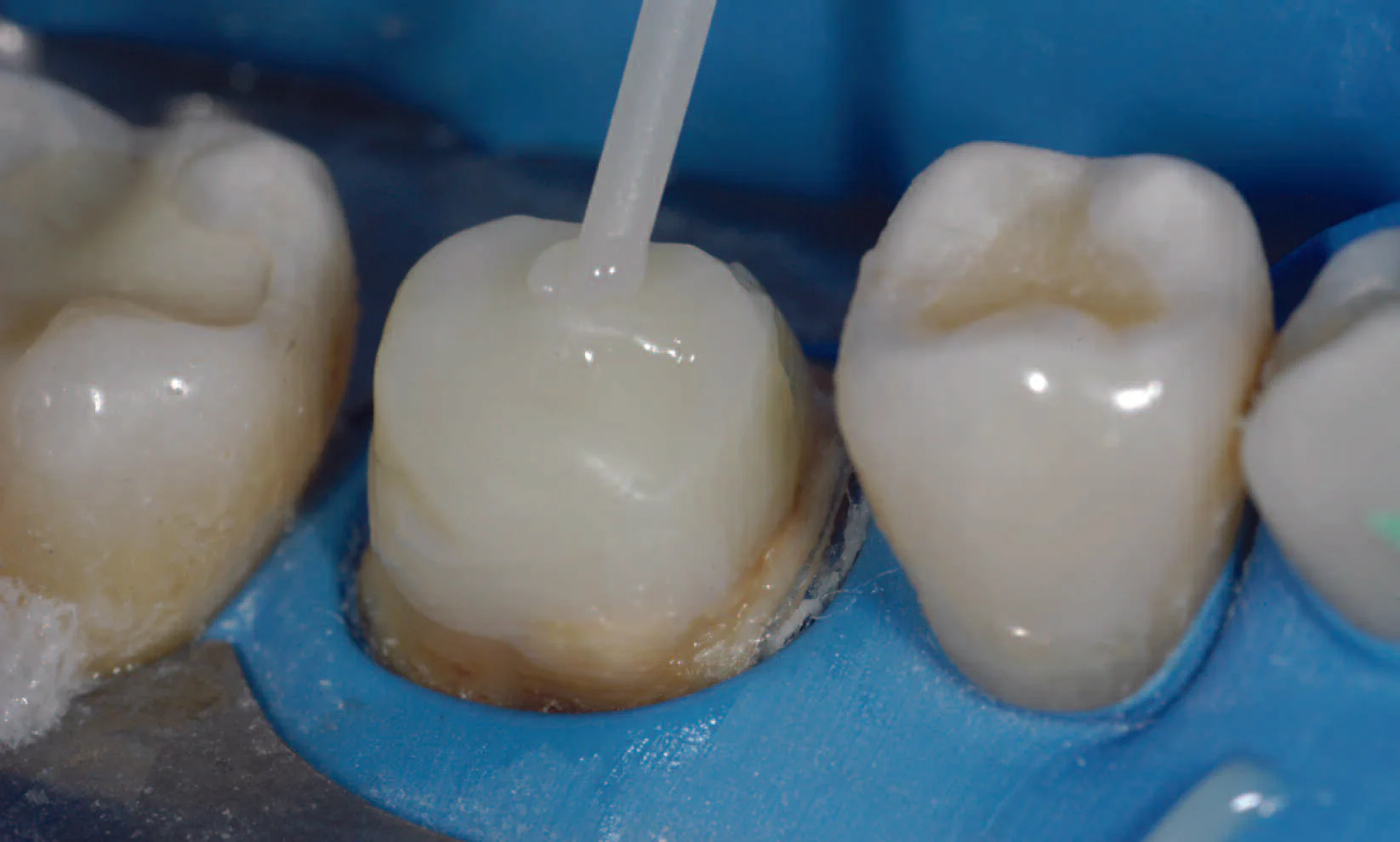 Core Build Up – Tagged