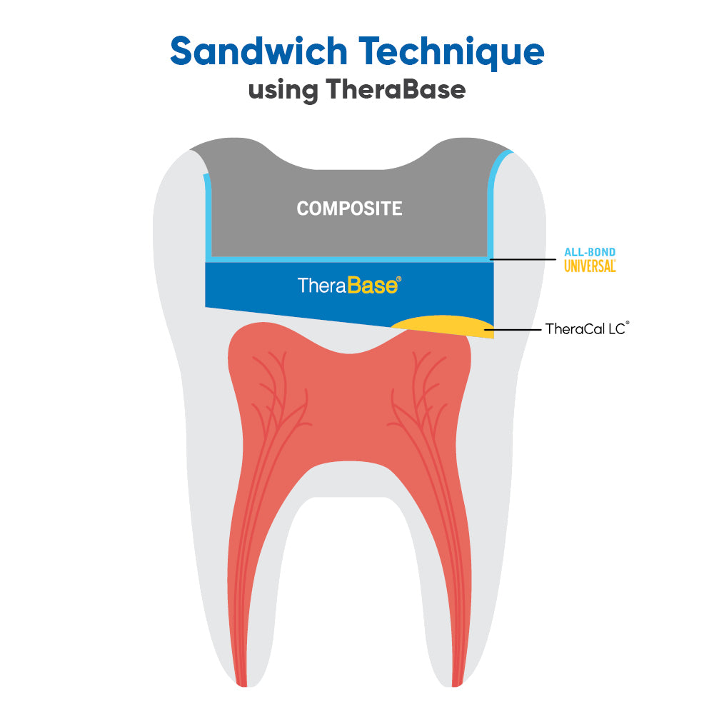Sandwich Technique Bundle | Curion Dental