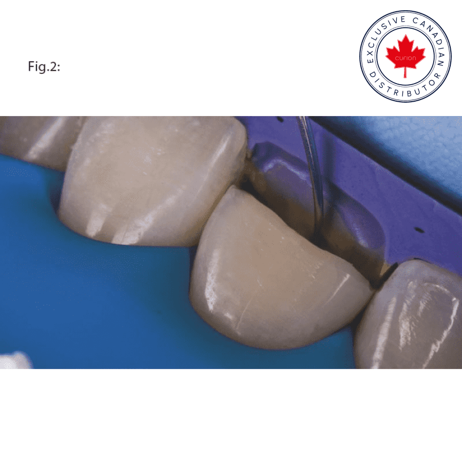 LM-Arte™ Fissura Curion Dental