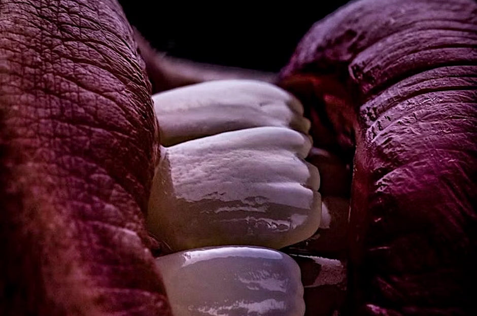 Maîtrise de l'esthétique des facettes antérieures : L'expérience du patient en direct