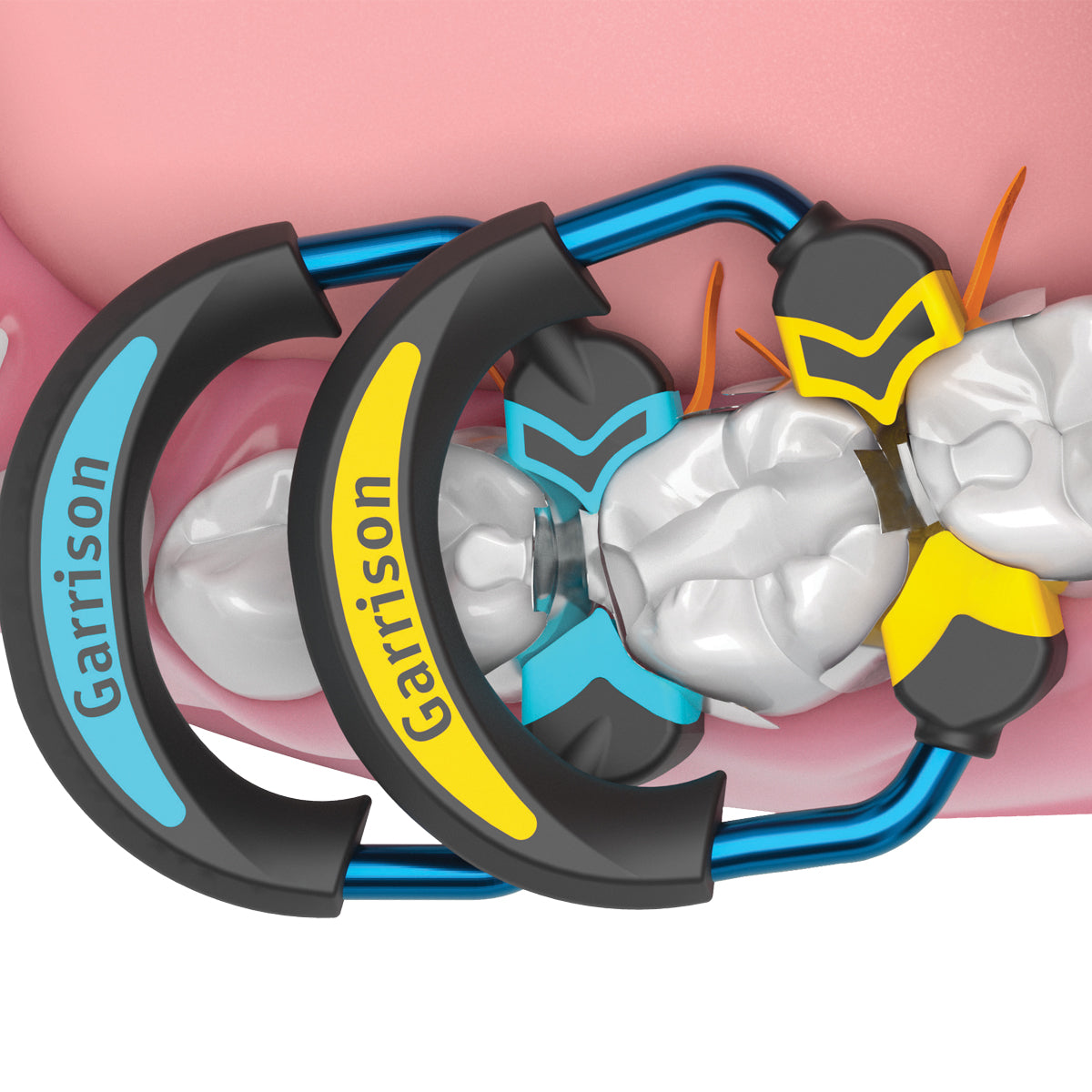 Quad Sectional Matrix System™ de Garrison Dental pour les restaurations composites de classe II multiples et dos à dos.