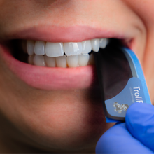 Bandes TrollFoil™ ultrafines pour un marquage précis du contact occlusal sur des dents humides ou sèches, Image clinique.